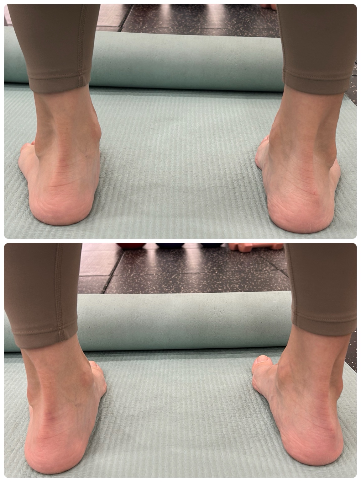 발목과 뒤꿈치 정렬 비교 기록